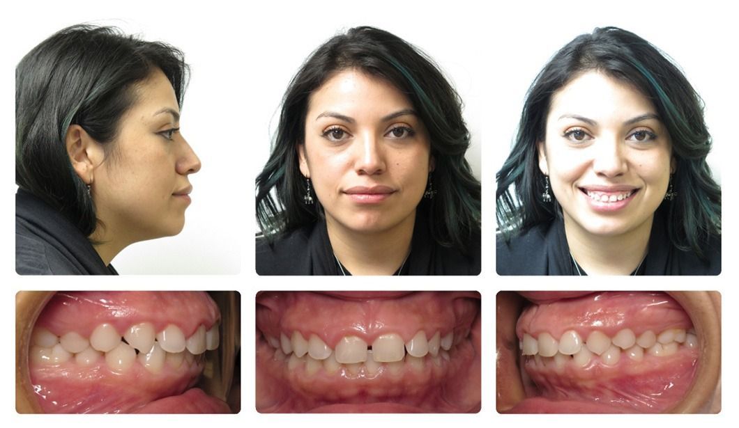 Invisalign Patient 9 — Before. Class 1 spacing, treated with Gingivectomy and Invisalign
