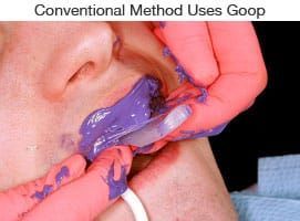 Traditional dental impression material used before digital scanning