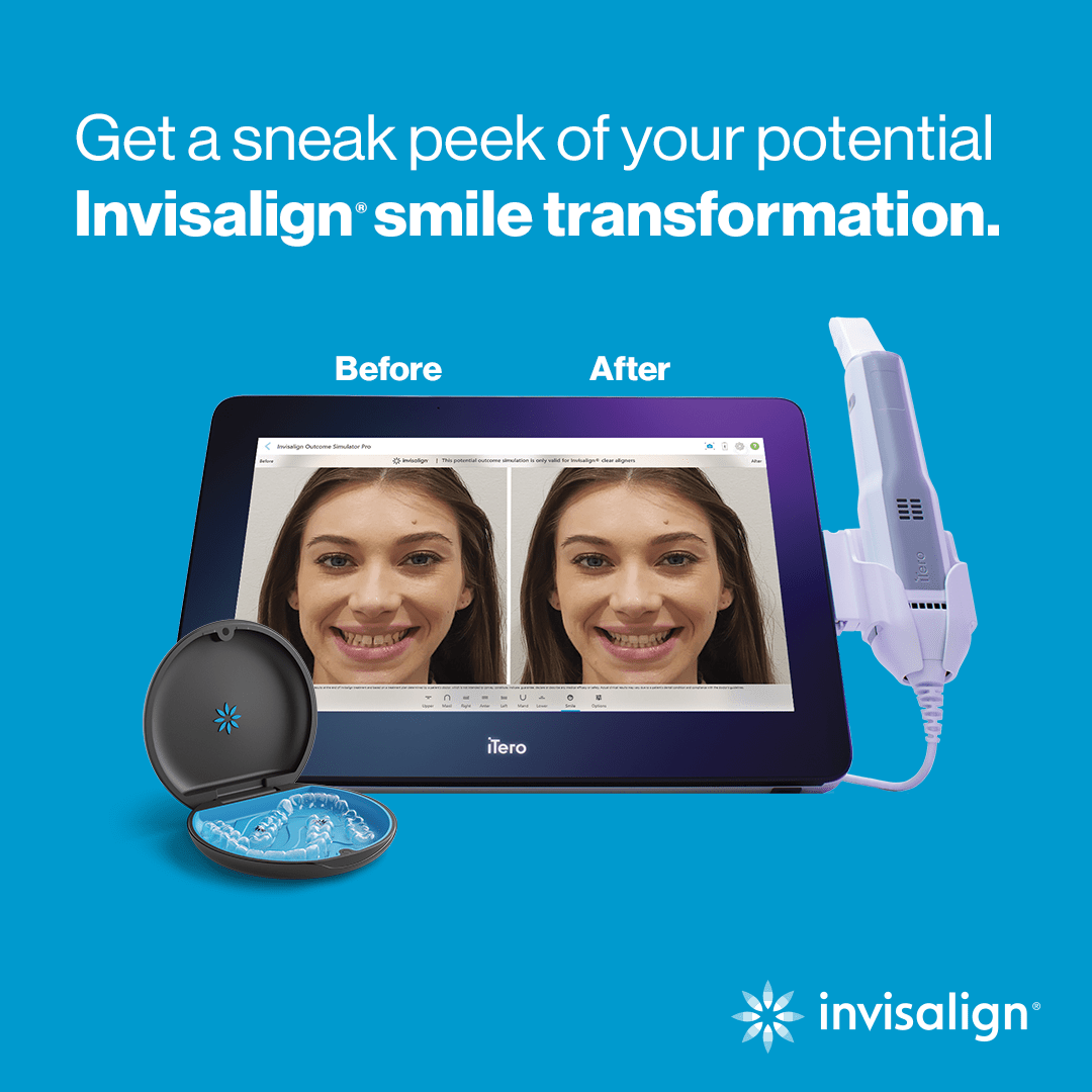 iTero digital scan displaying a simulated Invisalign smile transformation