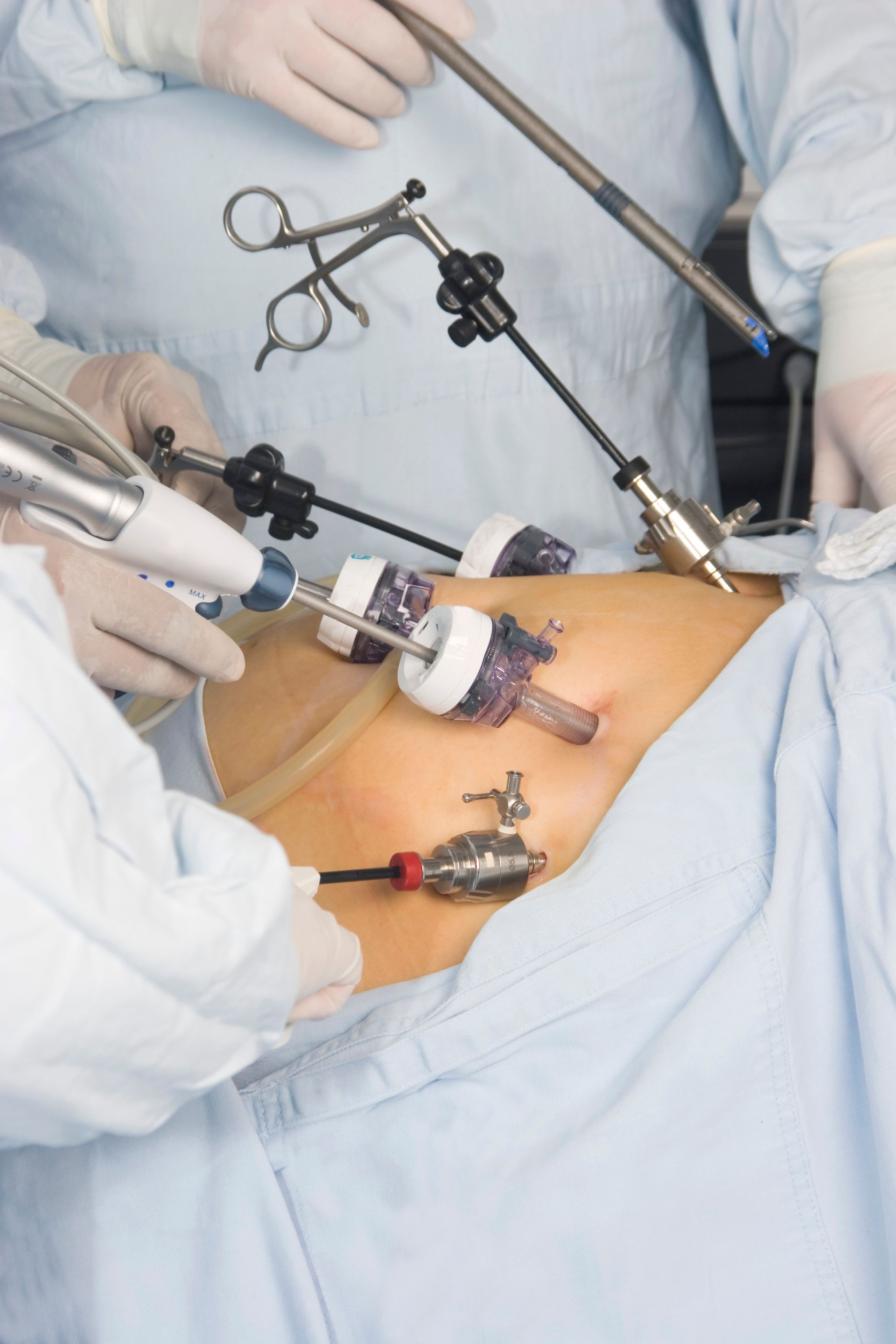 Cirugia_Urologica_Laparoscopica