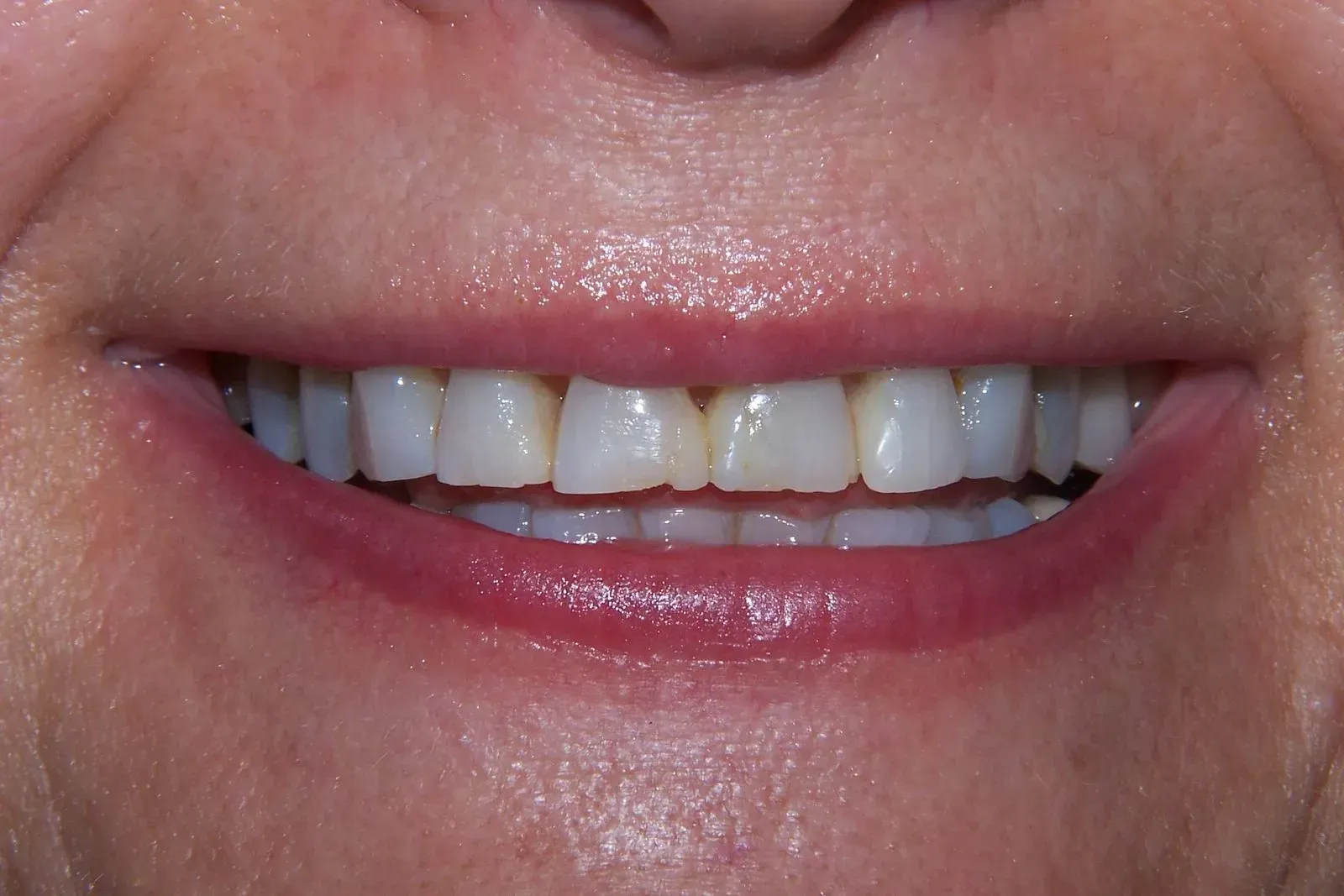 A close up of a woman 's mouth with white teeth.