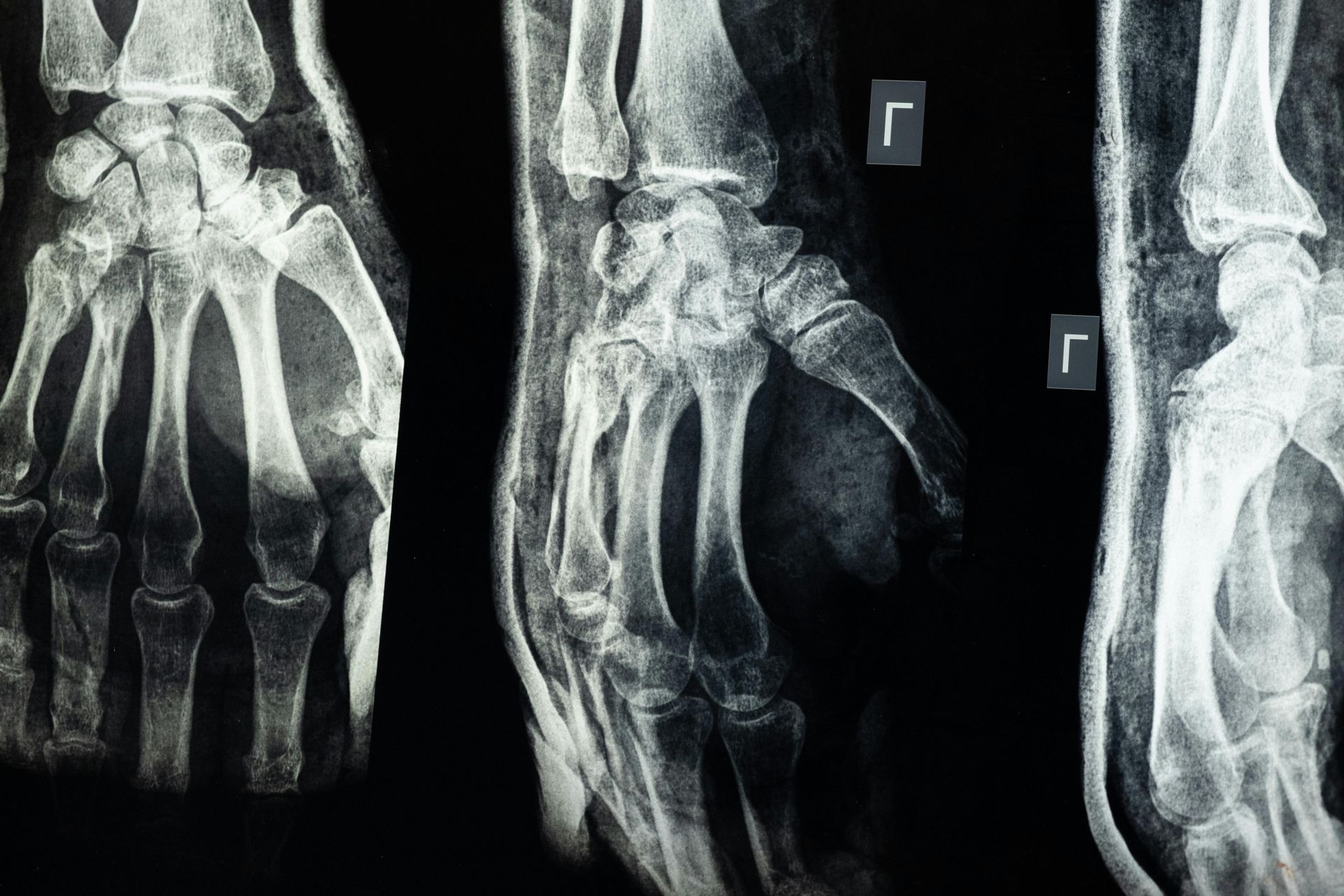 X-ray showing a broken hand with a cast, revealing fractures in the bones.