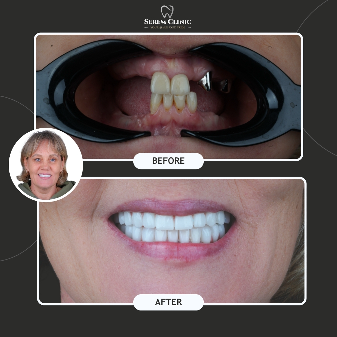 A split-screen dental clinic comparison showing a before image of missing teeth and an after image with a full smile.