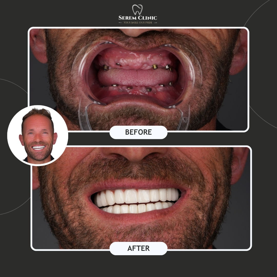 Dental before and after: a mouth with multiple implants followed by a full set of new, white teeth in a smile.