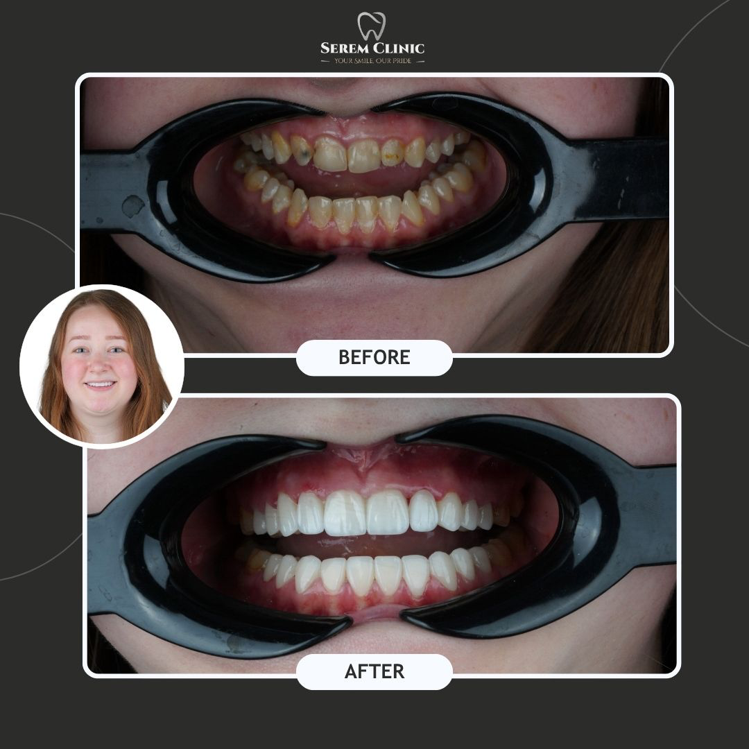 Before and after photos showing a dental patient's teeth transformation from stained to bright white.