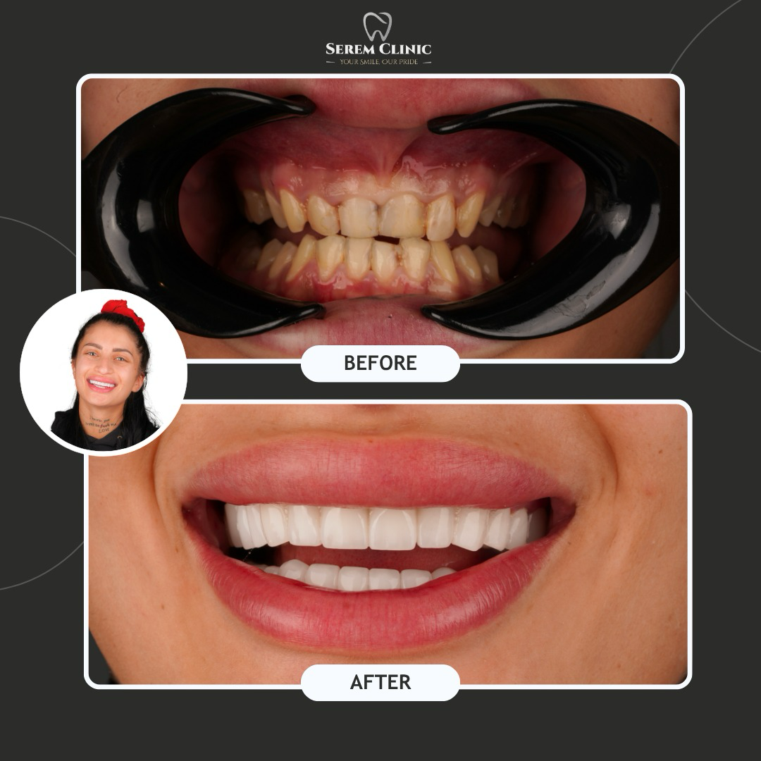 A before-and-after comparison showing teeth whitening and dental restoration results, featuring a smiling person.