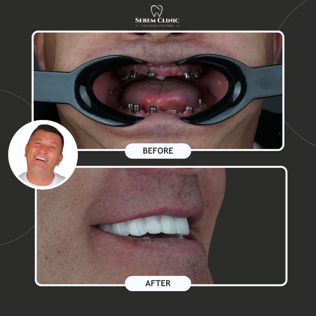 Before and after images of dental restoration showing metal implant abutments in the mouth and the final fixed teeth.