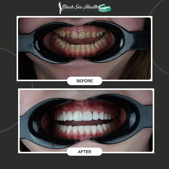 Before and after comparison of teeth, showing yellowed teeth above and bright white teeth below, viewed with retractors.