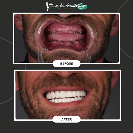 A dental patient's before-and-after comparison, showing oral implants replaced with a full set of new, white teeth.