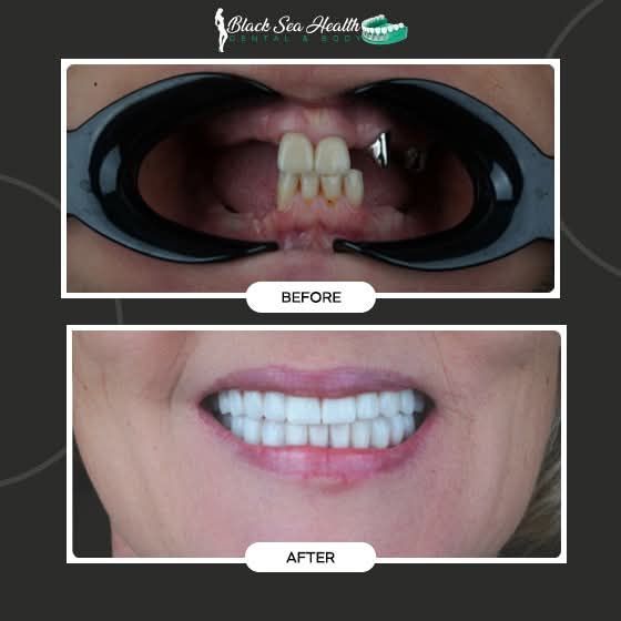 Before and after photos showing a dental restoration procedure, with missing teeth replaced by a full set of white teeth.
