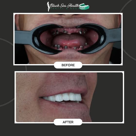 Dental before-and-after comparison: patient with implants shown before and after the placement of a dental bridge.