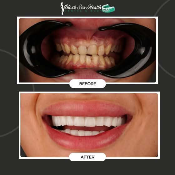 Before-and-after comparison of teeth, showing yellowed, misaligned teeth followed by white, straight veneers.