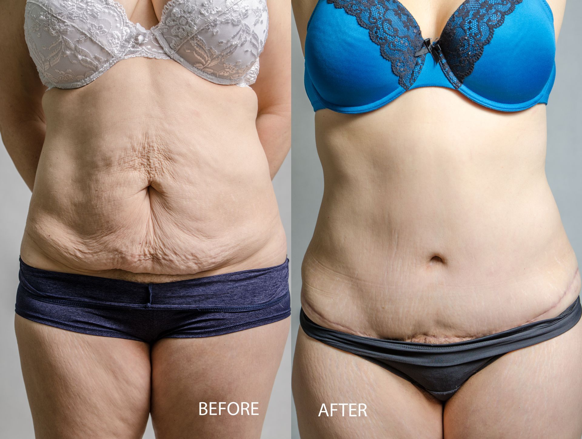 A comparison showing a patient's abdomen before and after a tummy tuck procedure, displaying skin tightening and a scar.