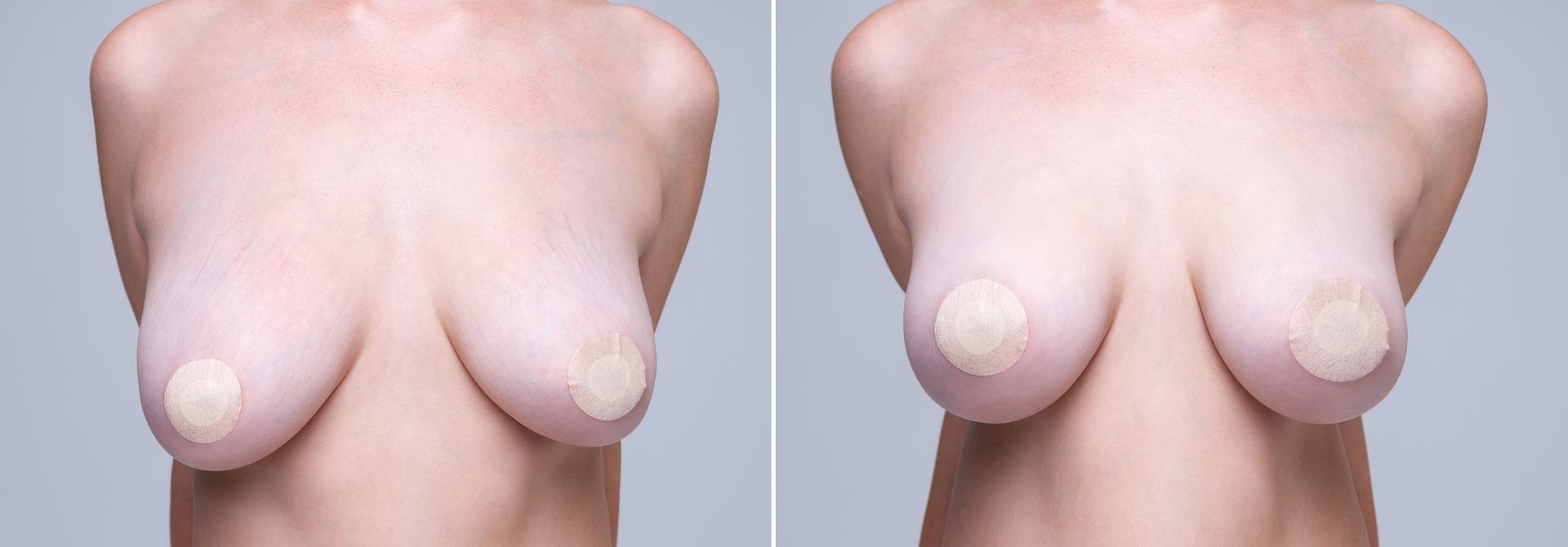 Before and after comparison of breasts, showing the results of a surgical procedure.
