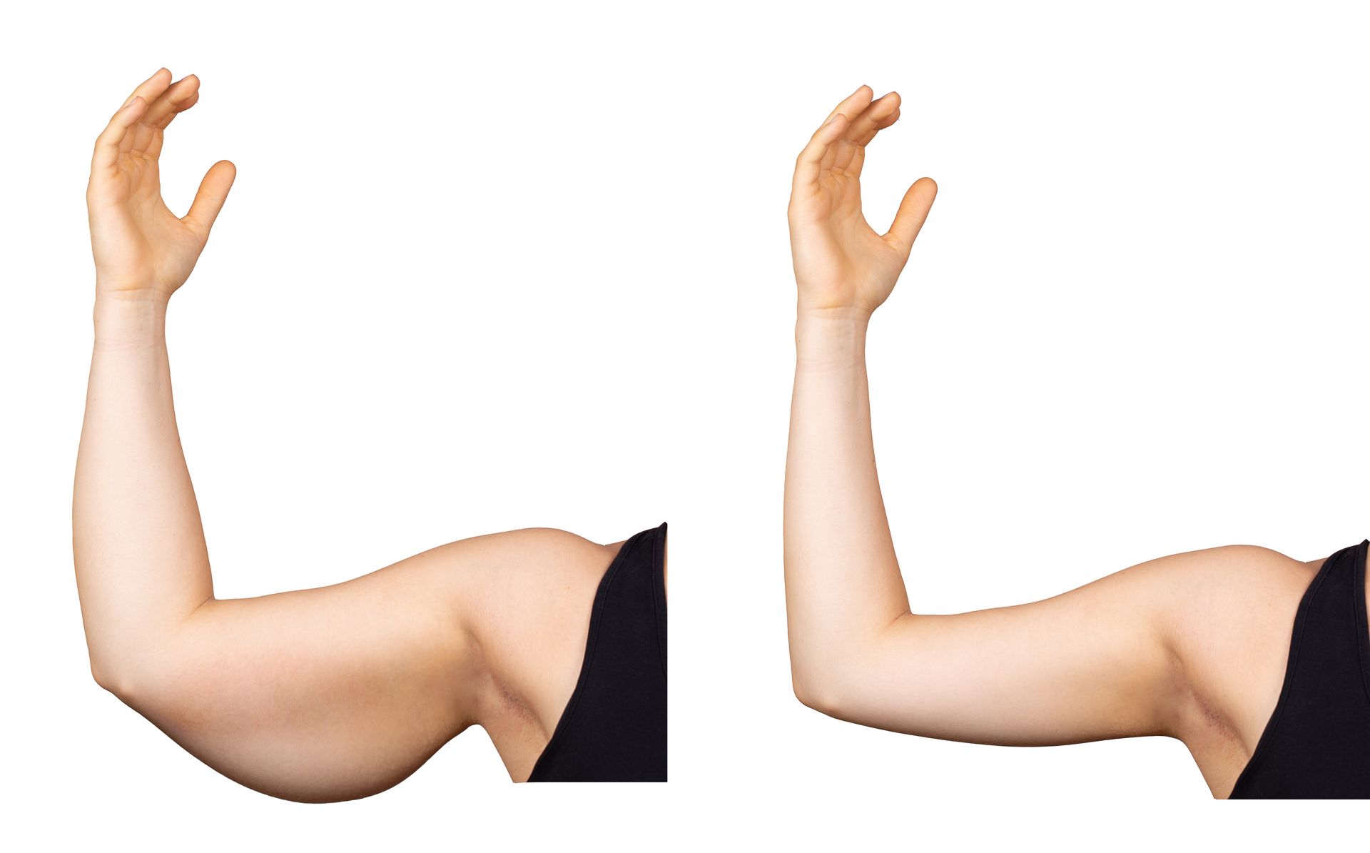Before-and-after comparison of a person's upper arm showing a reduction in loose skin and fat after a procedure.