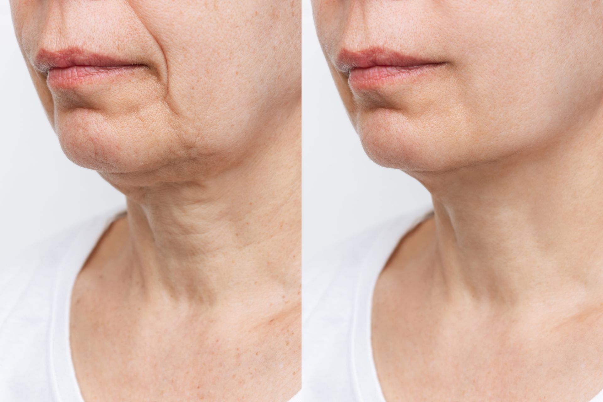 Before and after comparison of a person's lower face and neck showing reduced marionette lines and firmer, smoother skin.