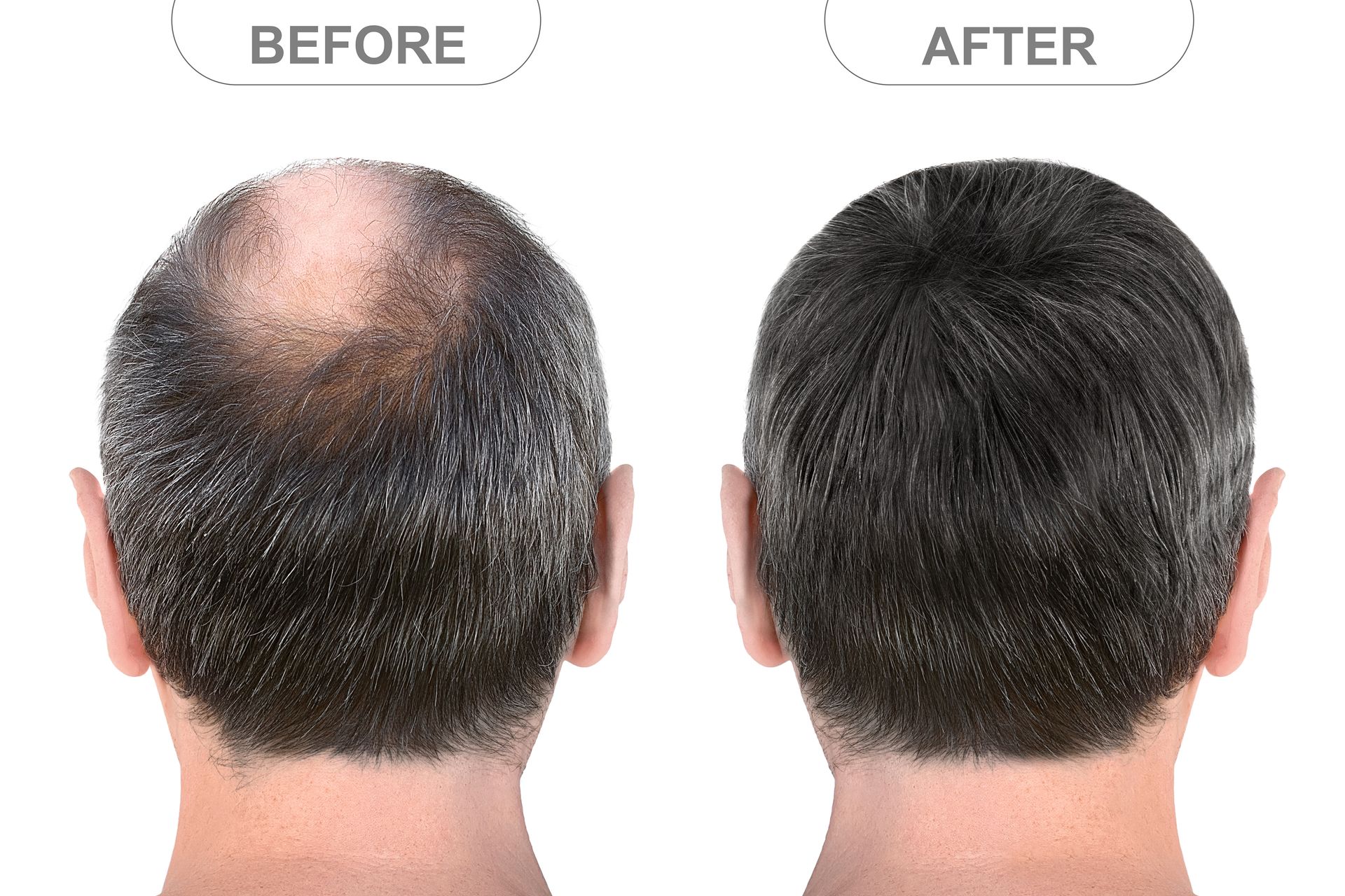 Before and after comparison of a person's scalp, showing hair regrowth in a bald spot on the crown of the head.