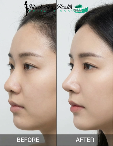 Before and after profile views of a person’s face showing subtle changes in nose shape and facial contours.