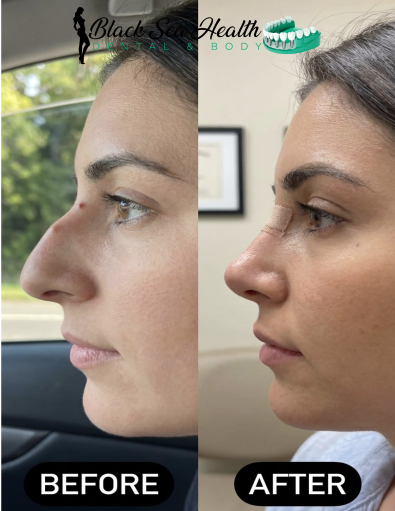 Side-by-side comparison of a nose before and after a cosmetic procedure, showing a smoother bridge profile.