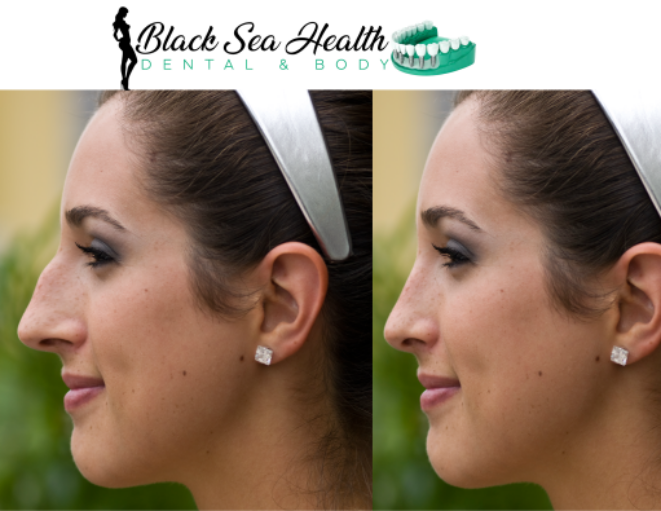 Before and after comparison of a nose reshaping procedure, displayed side-by-side on a Black Sea Health branded background.