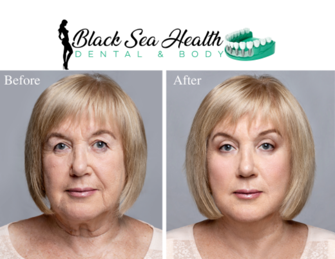Before-and-after comparison showing facial rejuvenation results from Black Sea Health Dental & Body.