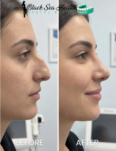 A side-by-side comparison of a person's profile before and after a non-surgical rhinoplasty procedure.