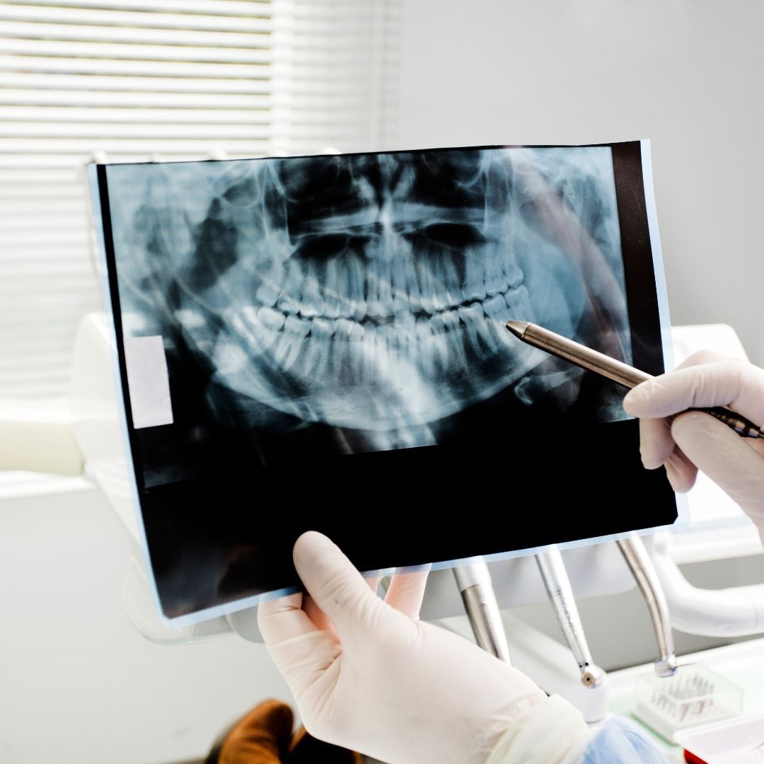 Dentist pointing to a panoramic X-ray of teeth, held in gloved hands in a dental office.