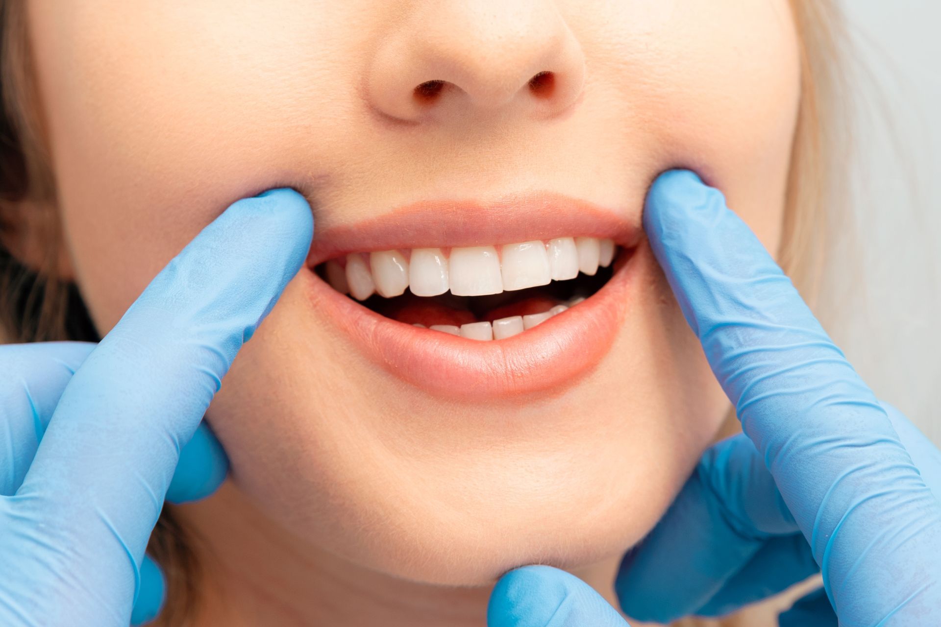 Close-up of a person's mouth with a dentist's gloved hands pulling back the cheeks, revealing bright, white teeth.