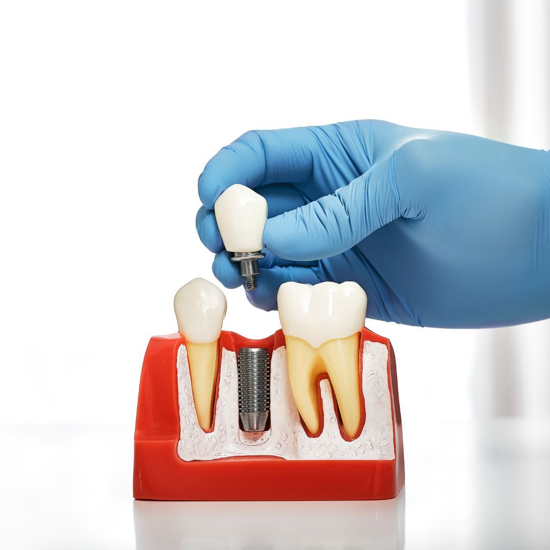 A gloved hand holds a dental implant model, placing a tooth on a screw-like implant in a red gum model, showing the parts of a tooth.
