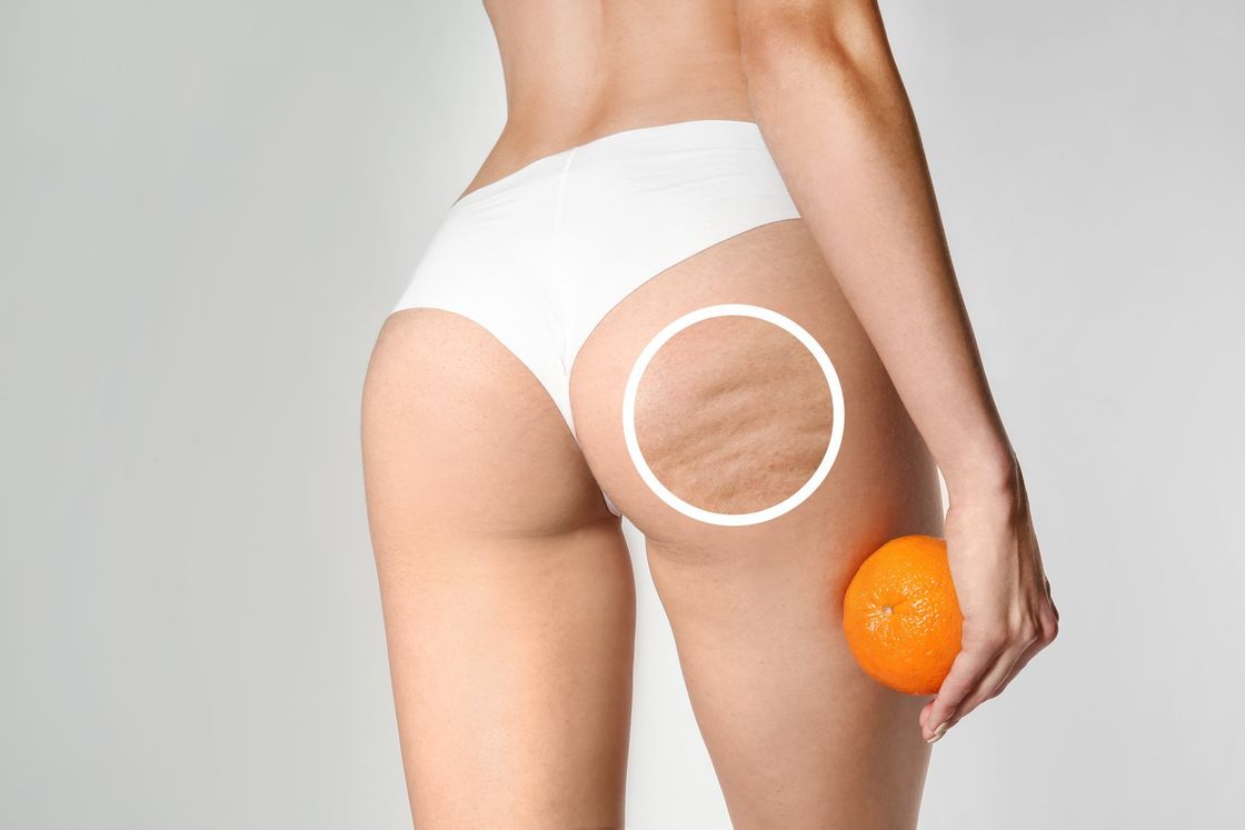 trattamento della cellulite