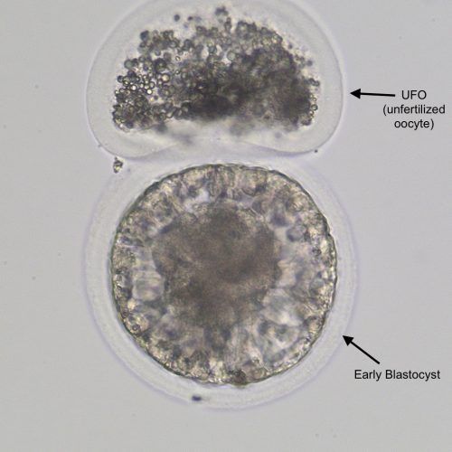 Grade 1 early blastocyst with an unfertilized oocyte (UFO) adhered to the zona pellucida.