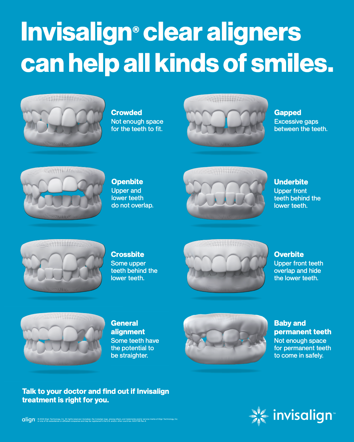 Invisalign Clear Aligners