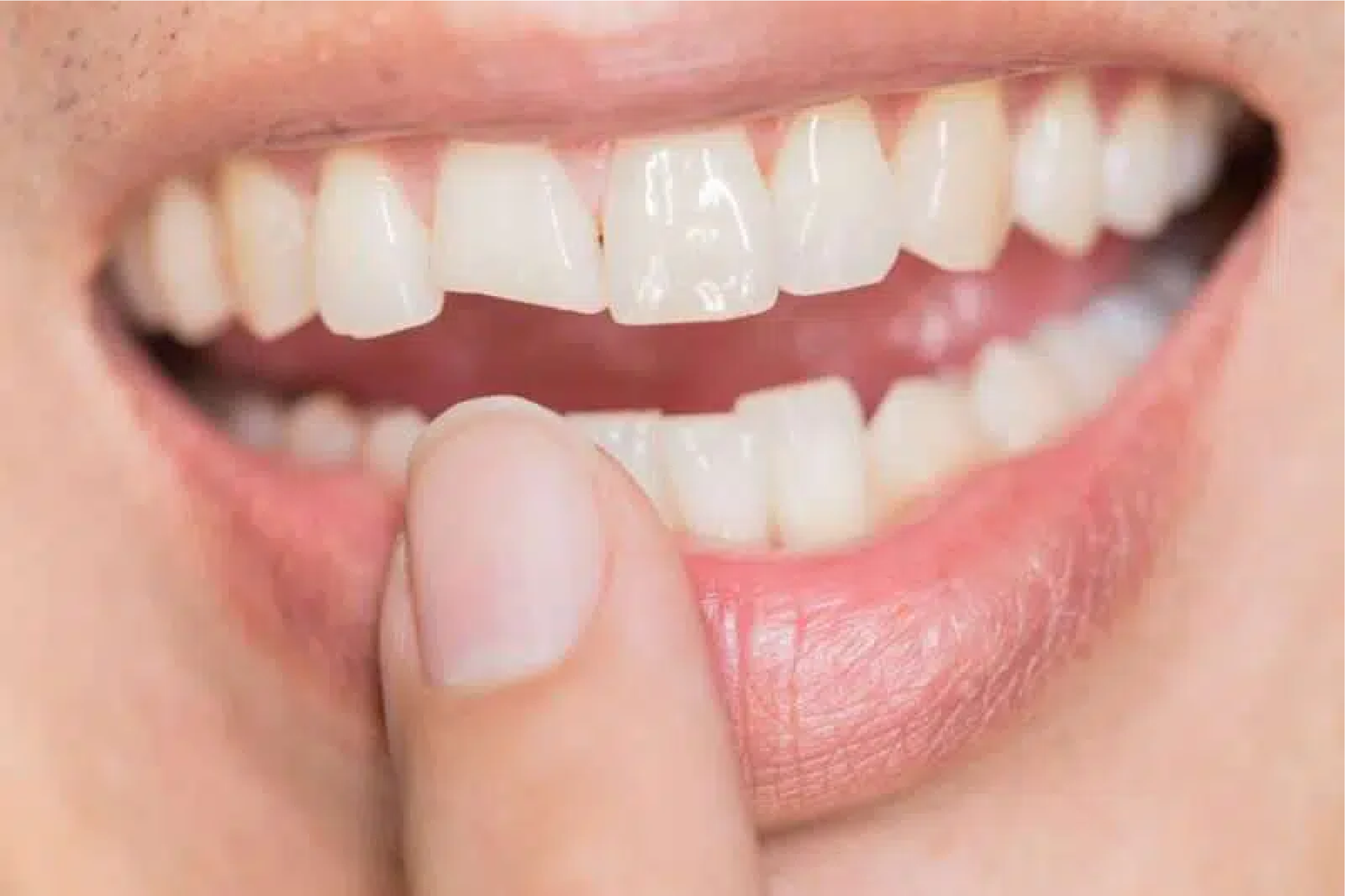 Cracked Tooth