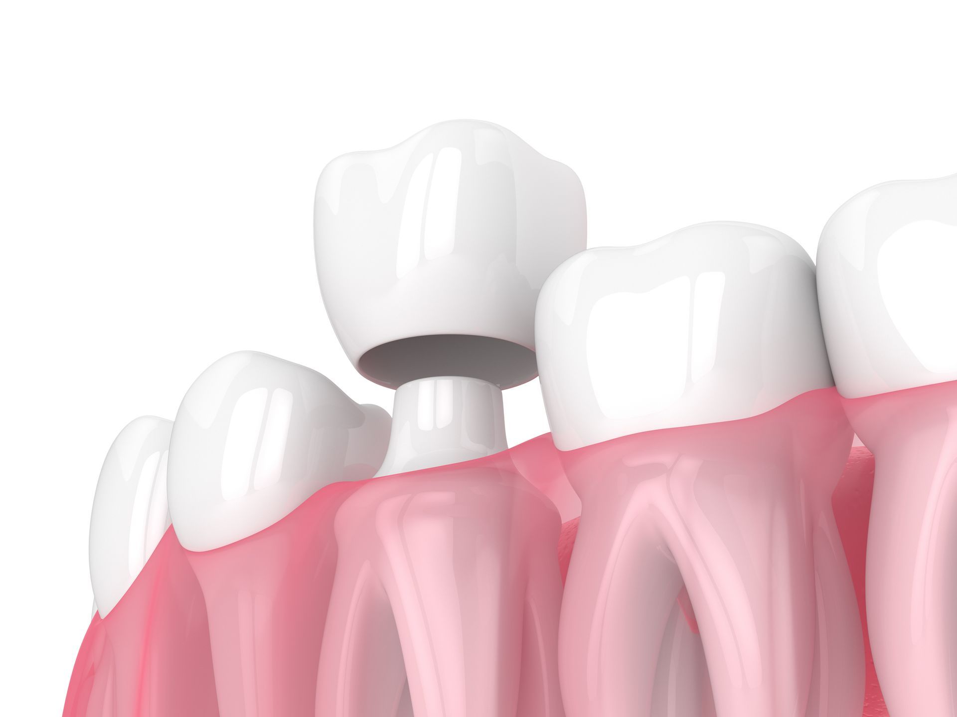 Restorative Crowns & Bridges