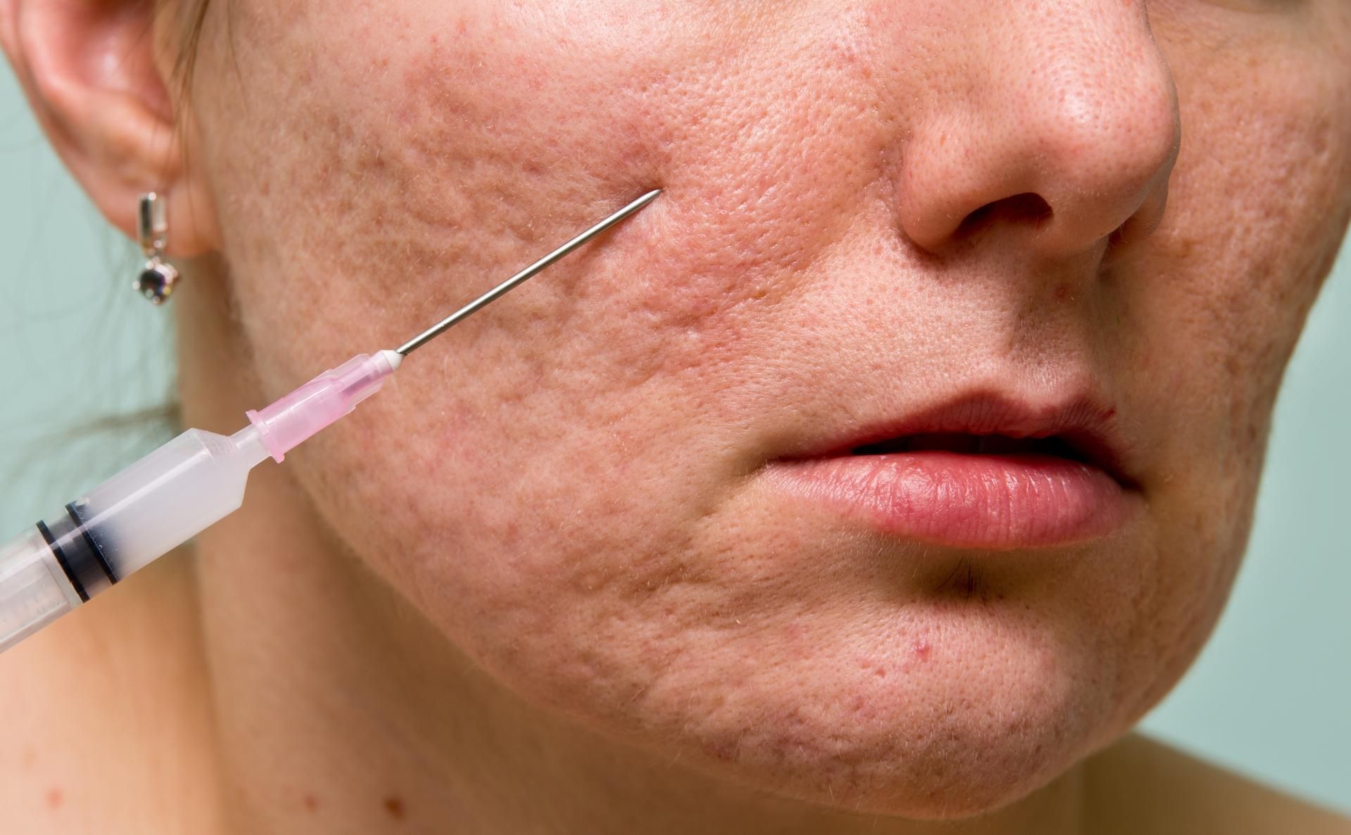 Woman's face with acne scars, receiving an injection with a syringe.