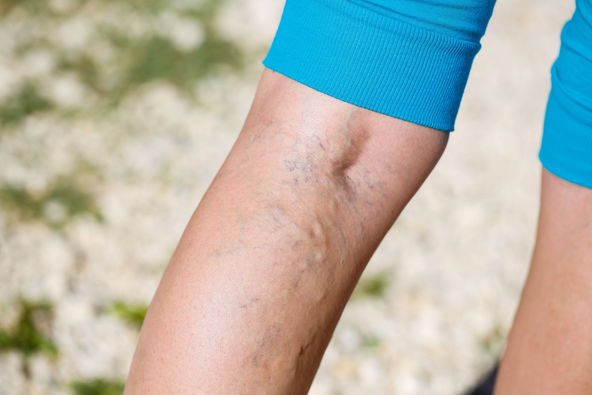 Leg with visible varicose veins, above the knee, wearing blue athletic shorts.