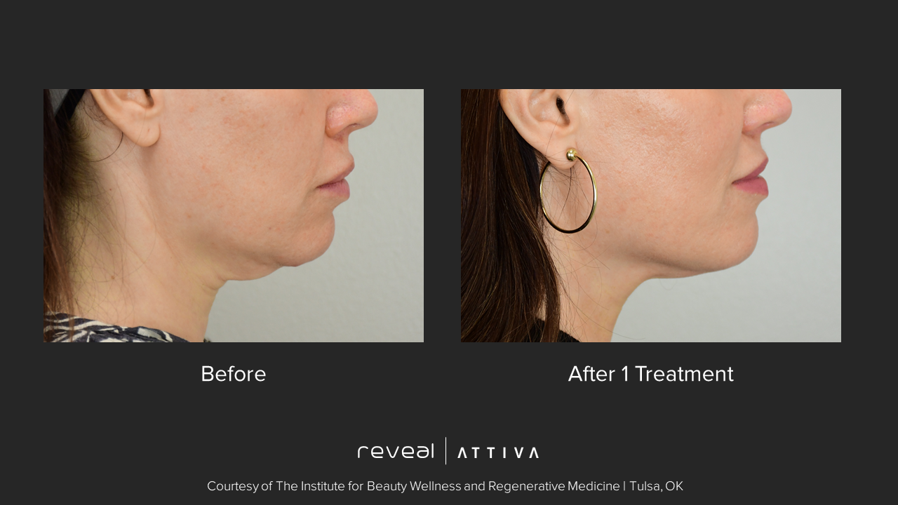 A before and after photo of a woman 's face with hoop earrings.  – Ponte Vedra Beach, FL – Ponte Vedra Vein & Aesthetics