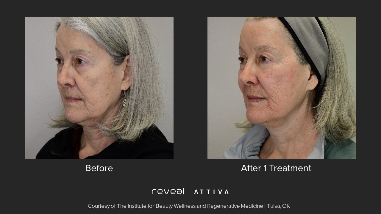 Before and after Attiva facial treatment. Shows an older woman's profile, with improved skin tone and texture.