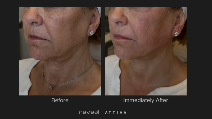 Before and after photos of a person's face and neck, showing reduced wrinkles after a treatment.
