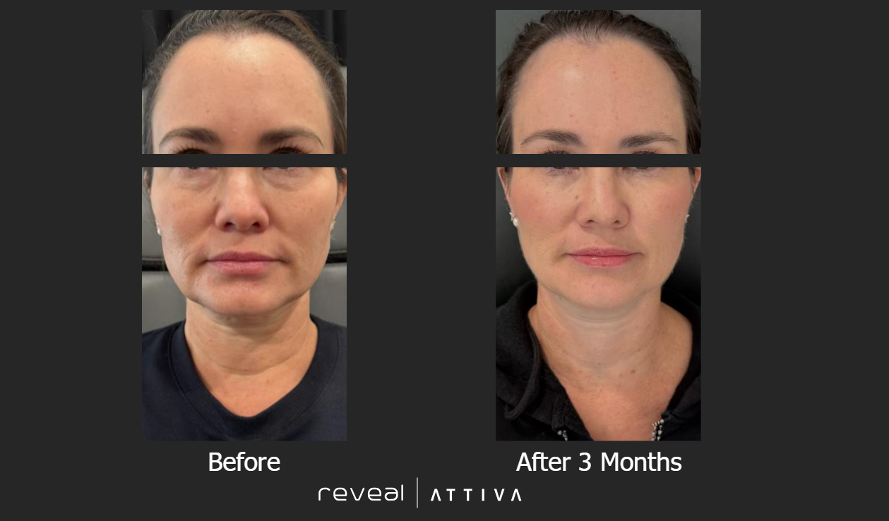 A before and after photo of a woman 's face – Ponte Vedra Beach, FL – Ponte Vedra Vein & Aesthetics