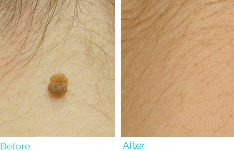 Before-and-after of a skin lesion: large brown mole on skin (before); smooth skin (after).