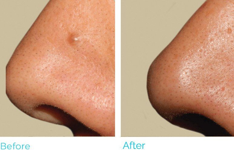 Before-and-after of a nose. The 