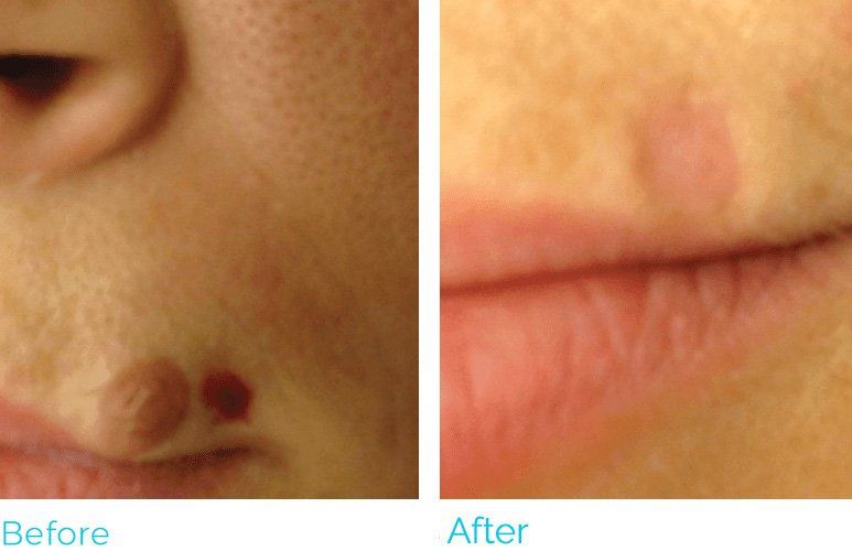 Before and after images of a skin lesion near the mouth, treated to remove the blemish.