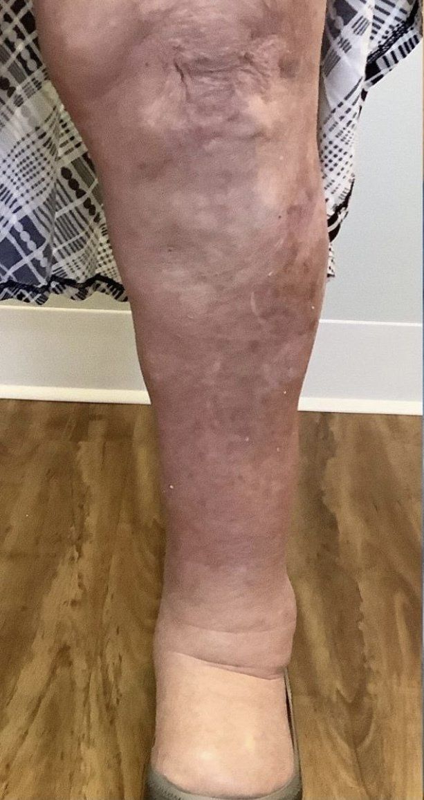 Leg with swollen ankle and discoloration. The skin appears mottled with a purplish hue.