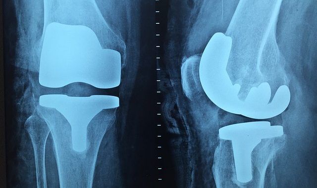 An X-Ray Of A Person Knee - Columbia, SC - Custom Assurance Placements