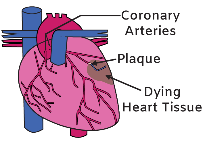 Heart attack illustration Heart attack illustration with arteries and dying tissue