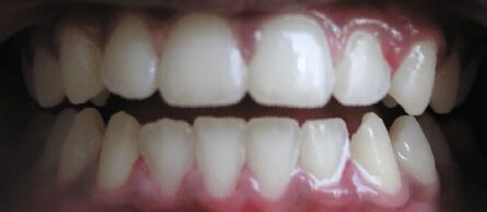 After Image of a mouth with straight teeth and no silver filling