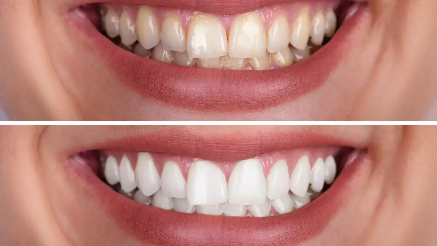 Comparison of teeth: before (yellowish) and after (bright white) whitening.