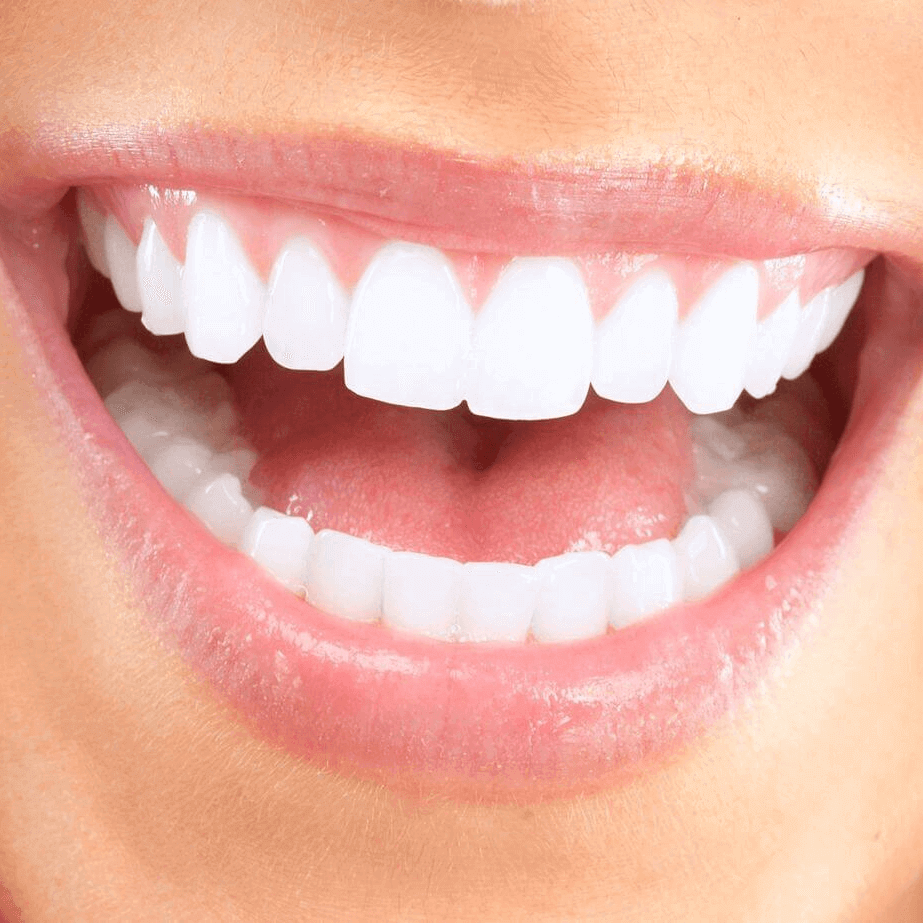 Teeth Whitening Treatments Christchurch Duxton Dental