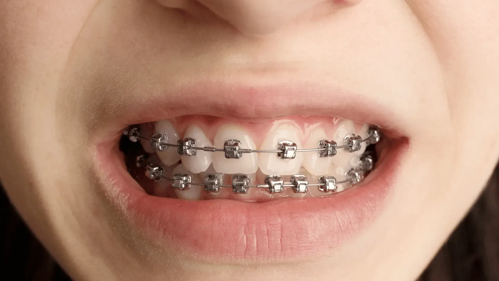 A close up of a person 's mouth with braces on their teeth.